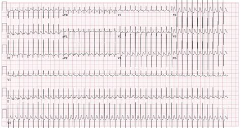 Svt Neonatal Supraventricular Tachycardia Svt American Academy Of