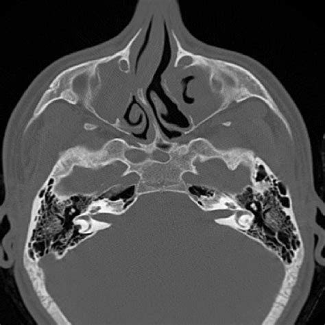 Axial Ct Scan Of The Sinuses Showing Sphenoid Sinus Hypoplasia In A