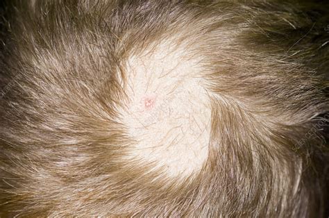 Traction Alopecia Of The Scalp Stock Image M1080756 Science