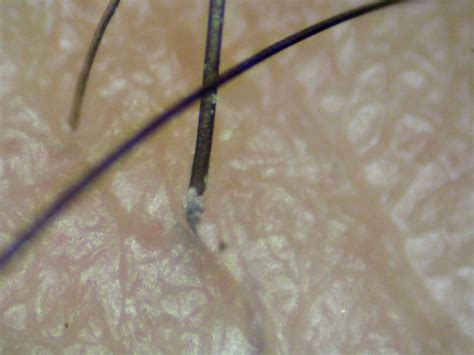 Infected Hair Follicle Causes Symptoms And Treatment