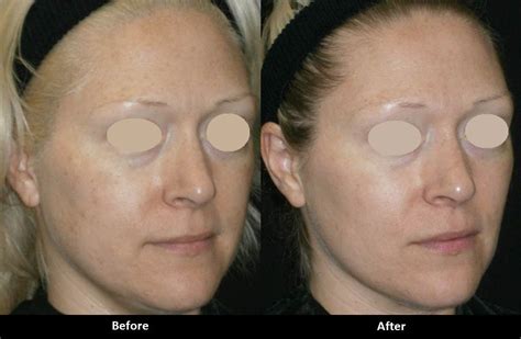 Forever Young Bbl Ipl Photofacial Before And After Med Spa In Encino