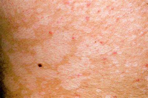 Pityriasis Versicolor Skin Infection Photograph By Dr P Marazzi