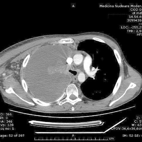The Chest Ct Scan Performed A Few Weeks After The End Of Radiotherapy