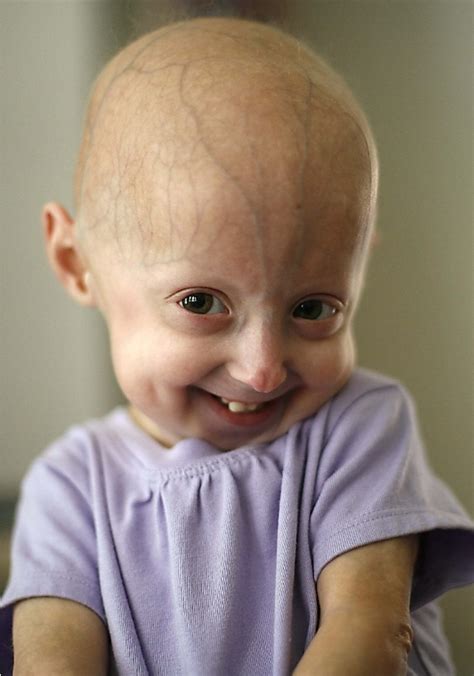 Due To A Genetic Disorder Called Progeria Some People Age At A