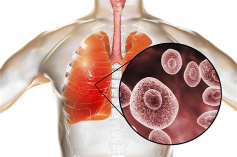 Pneumocystis Pneumonia Associated With Higher Mortality In