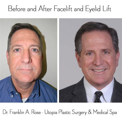 dr franklin rose reviews and houston plastic surgery blog dr franklin rose reviews new facelift