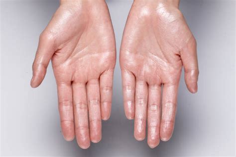 How To Get Rid Of Sweaty Hands Beverly Hills Med Spa