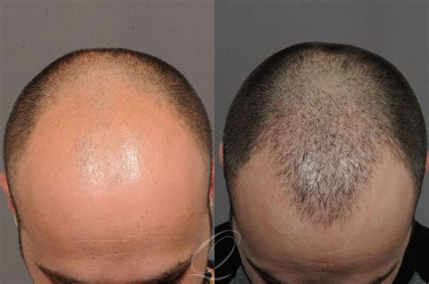 Male FUE Hair Transplant Before After Photos Patient 1055 Rochester