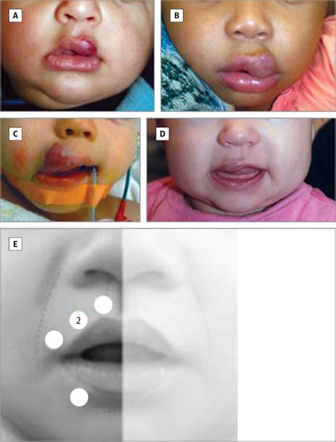 Distribution Clinical Characteristics And Surgical Treatment Of Lip