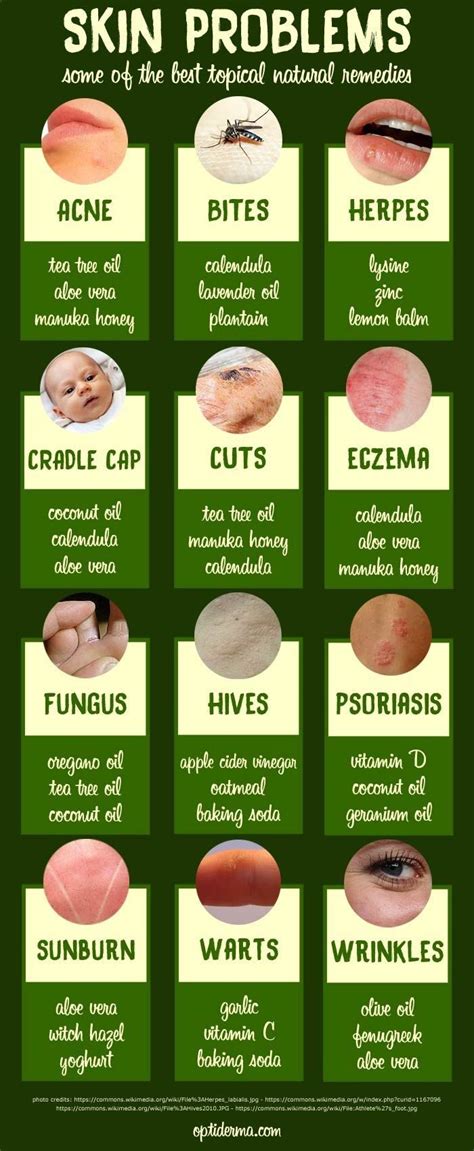 Natural Remedies For Skin Problems Infographic Natural Psoriasis