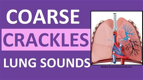 Rales Lung Sounds Infonorthwest