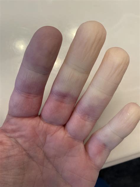 This Is What My Raynauds Looks Like Every Day In The Morning Its