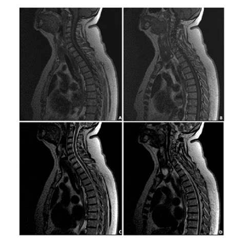 Spinal Cord Magnetic Resonance Imaging Sagittal Cervical A And