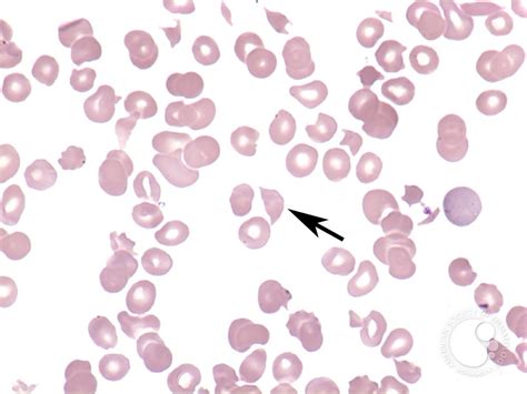 Microangiopathic Hemolytic Anemia 2