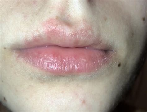 Skin Concern Discoloration Redness Around Lip Any Suggestions On How