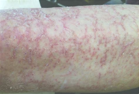 Asteatotic Eczema 69 Year Old Male Patient This Is A Complex