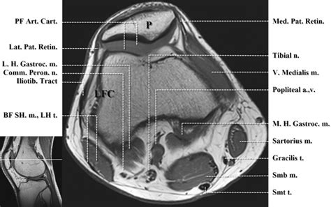 Magnetic resonance imaging (mri scan): Normal MR Imaging Anatomy of the Knee - Magnetic Resonance Imaging Clinics