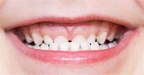 Malocclusione Dentale Cos Conseguenze Sintomi E Rimedi