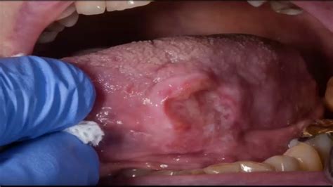 Aprende A Realizar Un Diagnostico Precoz Del Cancer Oral YouTube