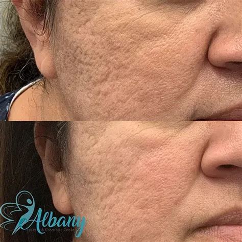 Bellafill For Scar Correction Results Albany Laser Case 1301