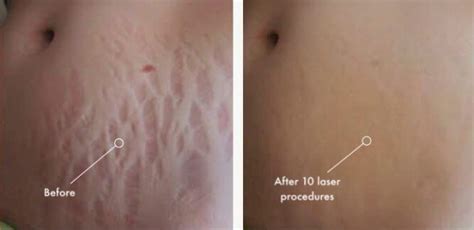 Stretch Marks Stretch Mark Removal With Laser
