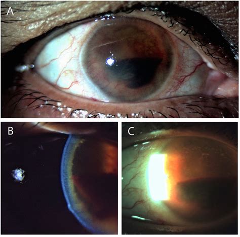 Disseminated Tuberculosis Involving The Eye Skin Axillary Lymph Nodes
