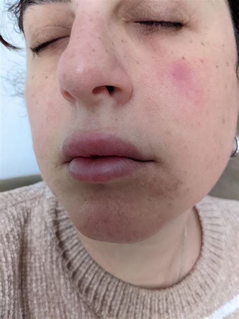 Help Acne Super Swollen Under Eye Bump Feels Like Pimple Where