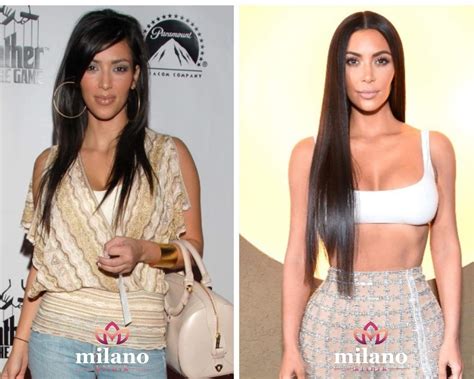 Kim Kardashian Plastic Surgeries Milano Klinik