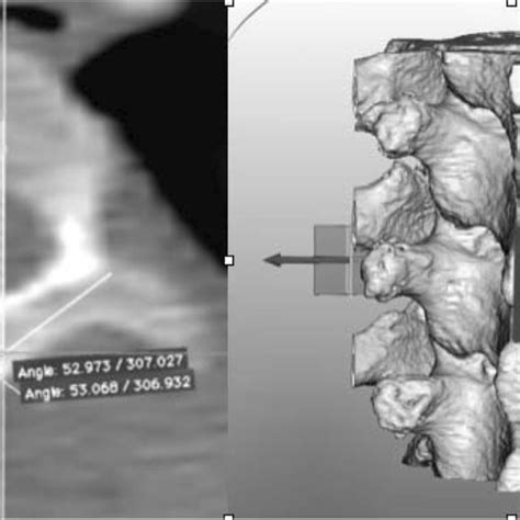 Left 3d Reconstructed Ct Scan Showing The Angle Measurement In The