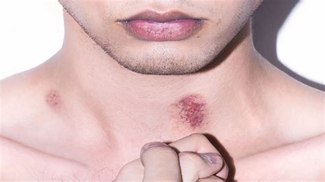 How To Get Rid Of A Hickey In 5 Minutes How To Get Rid Of A Hickey As