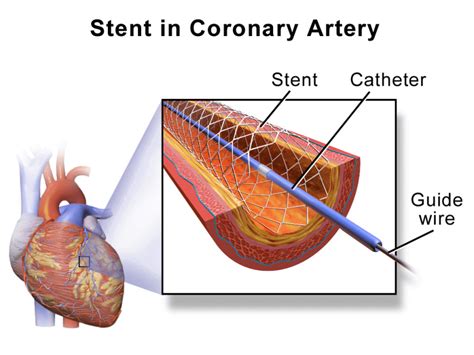 Coronary Angioplasty A Life Saving Procedure