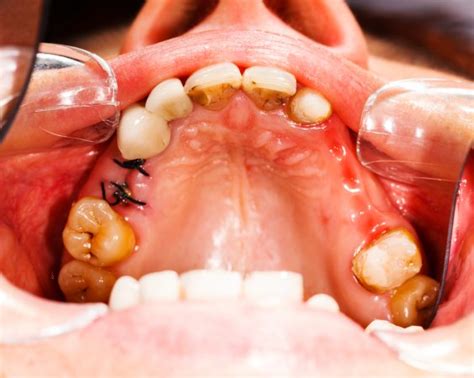 Extracción Dental Guía Completa Para Una Recuperación Rápida