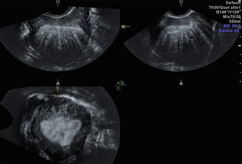 Using Adenomyosis Ultrasound For A Better Diagnosis Empowered Womens