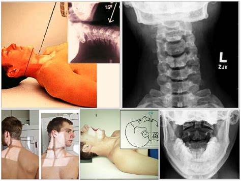 Cervical Spine Or Neck X Ray Radiography Radtechonduty