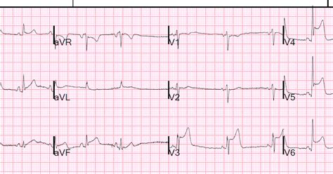 Dr Smiths Ecg Blog Is This A Stemi No Not By Definition Why Not