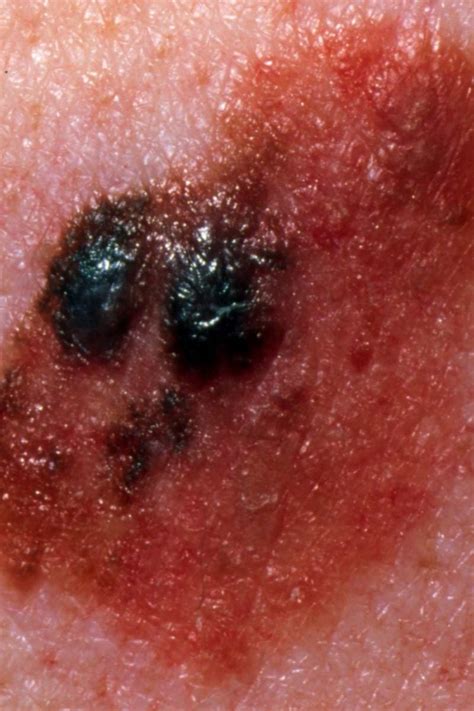 Stage Melanoma Survival Rate Pictures And Treatment