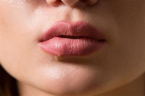 Aphte à la lèvre : comment le soigner ? | Focus-Senior