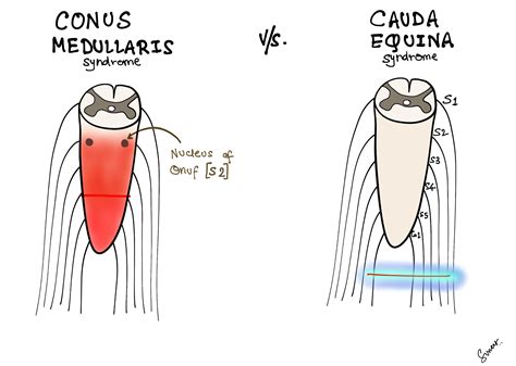 Medicowesome Conus Medullaris Syndrome Vs Cauda Equina Syndrome