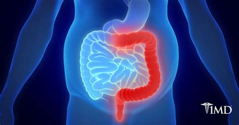 What Is Inflammatory Bowel Disease 1md