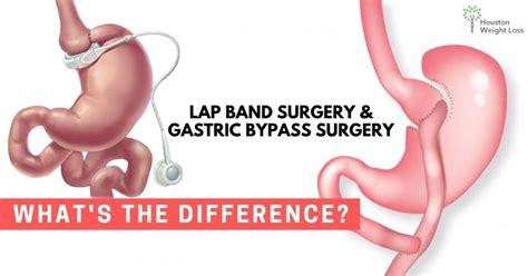 Lap Band Surgery And Gastric Bypass Surgery What’s The Difference Houston Weight Loss Surgical