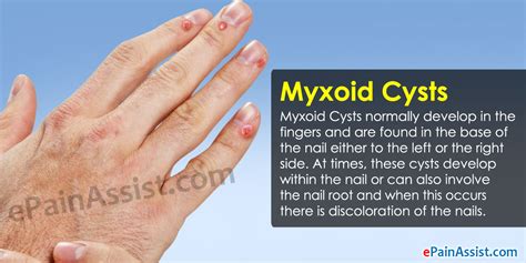 Myxoid Cyst Causes Pictures Photos
