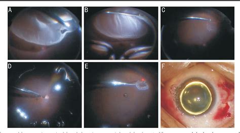 Figure 1 From Vitrectomy With Air Tamponade For Surgical Repair Of