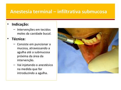 Anestesia Local Em Odontologia