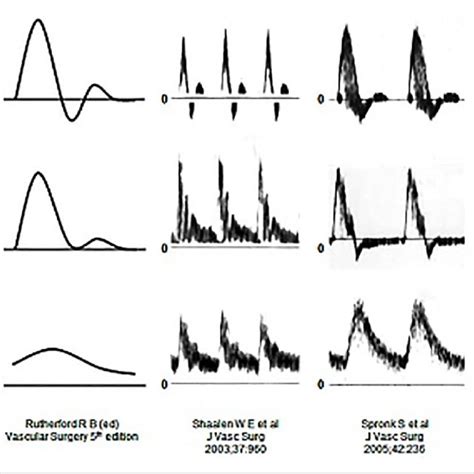 Spectral Doppler Waveforms Demonstrate Laminar A Disturbed B And