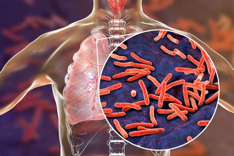 Tuberculosis (tb) is caused by bacteria (mycobacterium tuberculosis) that most often affect the lungs. Could a New Universal Tuberculosis Regimen Help End the TB ...