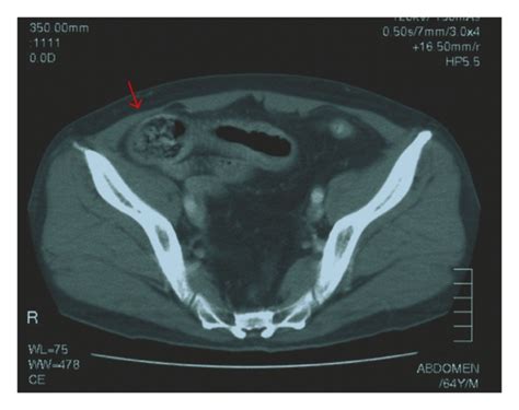 Pelvic Ct Shows A Dilated Small Bowel Loop And A Mass Measuring 4 Cm Download Scientific Diagram