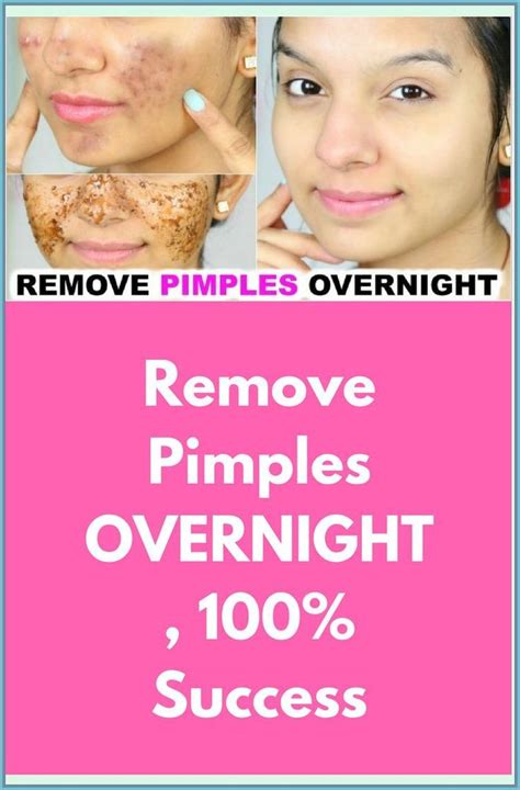 How To Remove Acne Overnight Acne Overnight Remove Acne Pimples