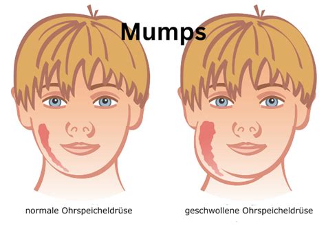 Mumps Disease Sign Symptoms Treatment And Complication