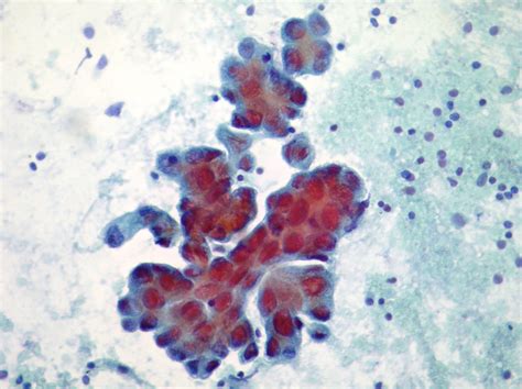 Cytopathology Of Lymph Nodes Fnac Cellnetpathology