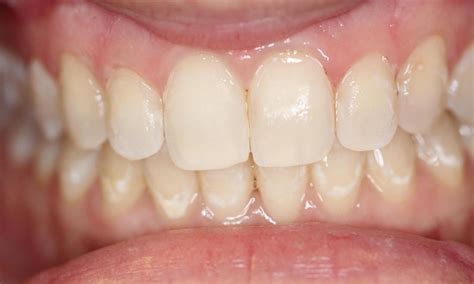 White Lines On Teeth Near Gums Teethwalls